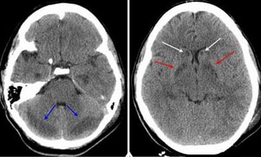 Primary Causes of Cerebral Edema (Brain Swelling)